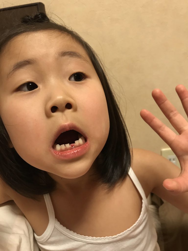 こっちゃん、歯が抜けました！